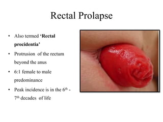 Rectal Prolapse
• Also termed ‘Rectal
procidentia’
• Protrusion of the rectum
beyond the anus
• 6:1 female to male
predominance
• Peak incidence is in the 6th -
7th decades of life
 