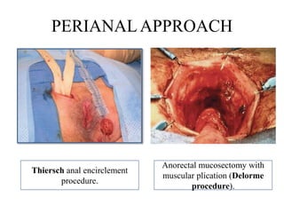 Thiersch anal encirclement
procedure.
Anorectal mucosectomy with
muscular plication (Delorme
procedure).
PERIANALAPPROACH
 