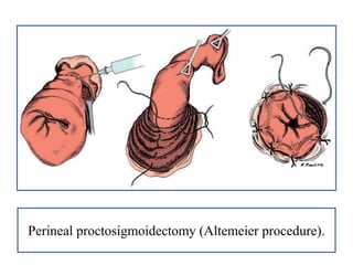 Perineal proctosigmoidectomy (Altemeier procedure).
 