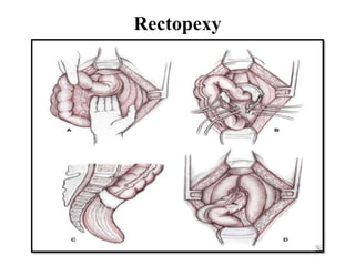 Rectopexy
 