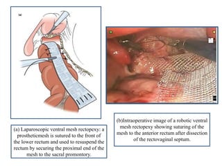(a) Laparoscopic ventral mesh rectopexy: a
prostheticmesh is sutured to the front of
the lower rectum and used to resuspend the
rectum by securing the proximal end of the
mesh to the sacral promontory.
(b)Intraoperative image of a robotic ventral
mesh rectopexy showing suturing of the
mesh to the anterior rectum after dissection
of the rectovaginal septum.
 