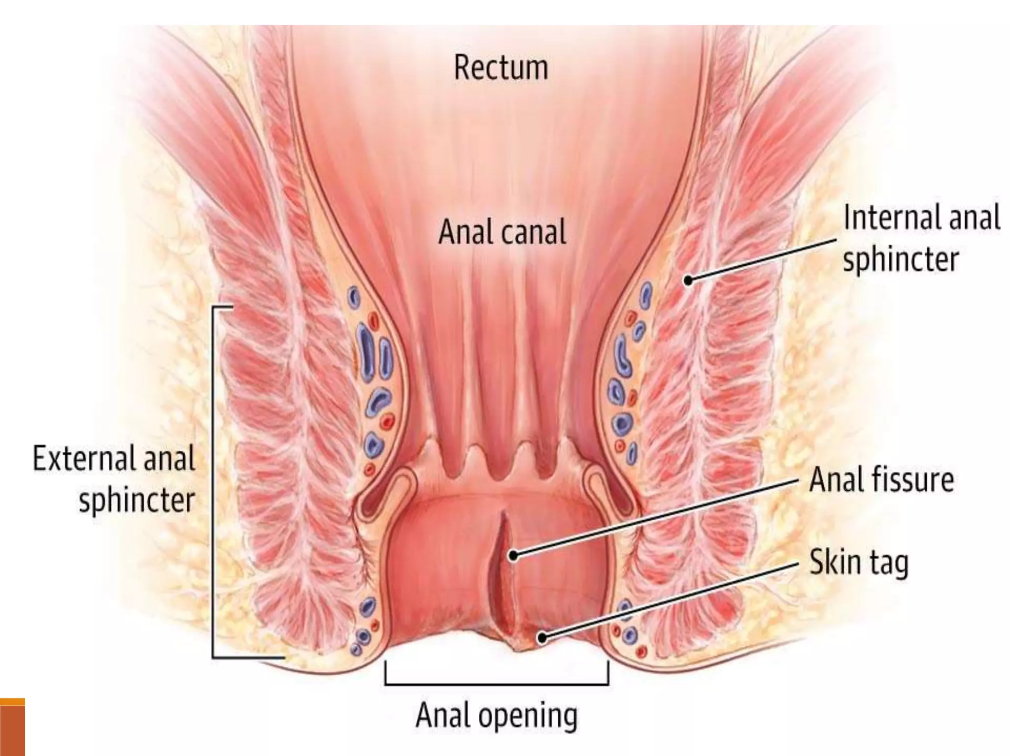 anorectal-fissure-abscess-fistula-pptx