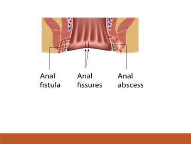 Rectal Abscess Fistula Rectovaginal Fistula YLIMGZ rectal-abscess-fistula-rectovaginal-fistula-ylimgz