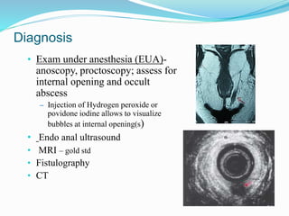 Diagnosis
• Exam under anesthesia (EUA)-
anoscopy, proctoscopy; assess for
internal opening and occult
abscess
– Injection of Hydrogen peroxide or
povidone iodine allows to visualize
bubbles at internal opening(s)
• Endo anal ultrasound
• MRI – gold std
• Fistulography
• CT
 