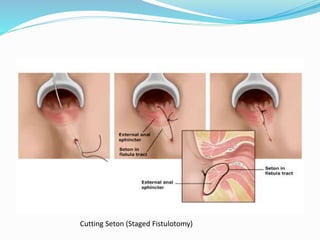 Cutting Seton (Staged Fistulotomy)
 