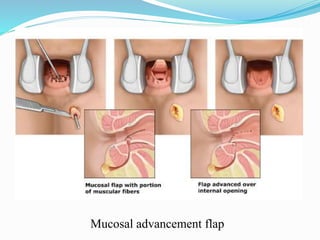 Mucosal advancement flap
 