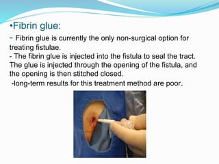 •Fibrin glue:
- Fibrin glue is currently the only non-surgical option for
treating fistulae.
- The fibrin glue is injected into the fistula to seal the tract.
The glue is injected through the opening of the fistula, and
the opening is then stitched closed.
-long-term results for this treatment method are poor.
 