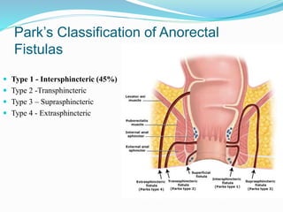 Park’s Classification of Anorectal
Fistulas
 Type 1 - Intersphincteric (45%)
 Type 2 -Transphincteric
 Type 3 – Suprasphincteric
 Type 4 - Extrasphincteric
 