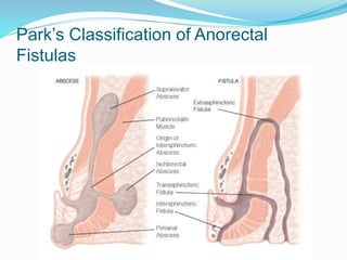 Park’s Classification of Anorectal
Fistulas
 