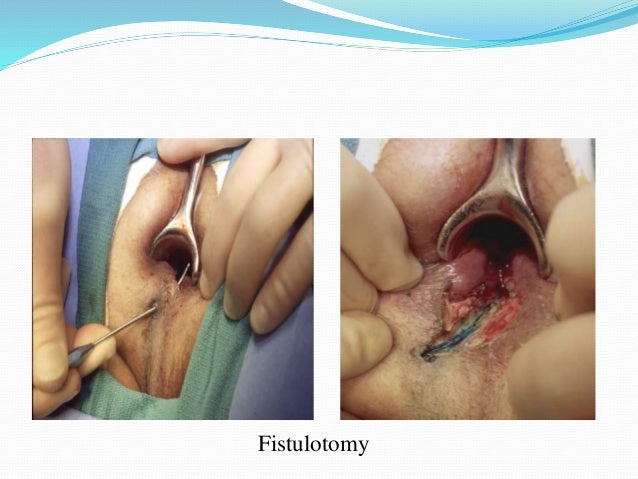 Anal Fistulotomy 114