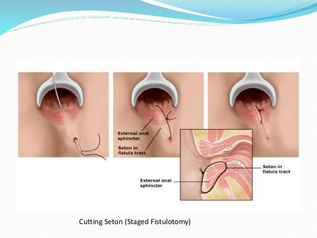 Anal fistula plug