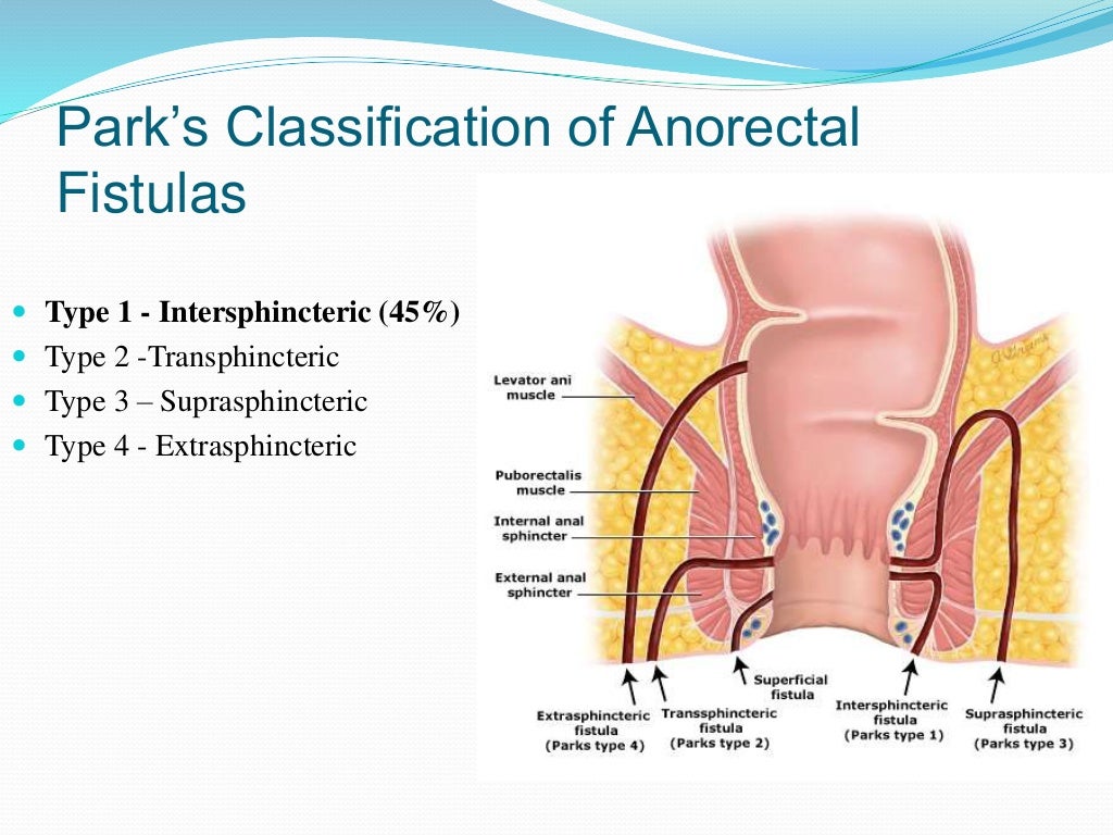 anorectal-fistula