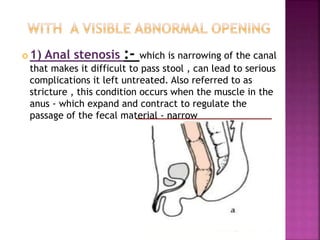  1) Anal stenosis :- which is narrowing of the canal
that makes it difficult to pass stool , can lead to serious
complications it left untreated. Also referred to as
stricture , this condition occurs when the muscle in the
anus - which expand and contract to regulate the
passage of the fecal material - narrow
 