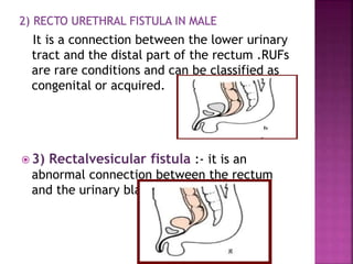 It is a connection between the lower urinary
tract and the distal part of the rectum .RUFs
are rare conditions and can be classified as
congenital or acquired.
 3) Rectalvesicular fistula :- it is an
abnormal connection between the rectum
and the urinary bladder .
 