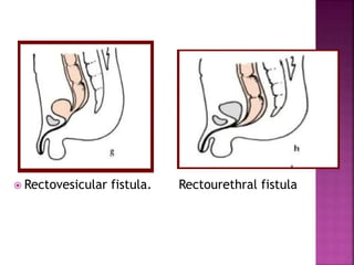  Rectovesicular fistula. Rectourethral fistula
 