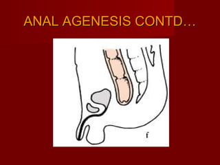 Anorectal malformation PPT