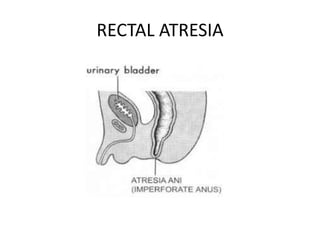 RECTAL ATRESIA
 
