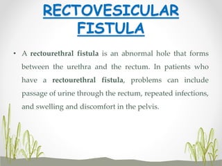 RECTOVESICULAR
FISTULA
• A rectourethral fistula is an abnormal hole that forms
between the urethra and the rectum. In patients who
have a rectourethral fistula, problems can include
passage of urine through the rectum, repeated infections,
and swelling and discomfort in the pelvis.
 