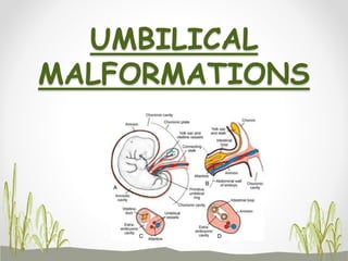 UMBILICAL
MALFORMATIONS
 