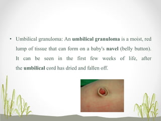 • Umbilical granuloma: An umbilical granuloma is a moist, red
lump of tissue that can form on a baby's navel (belly button).
It can be seen in the first few weeks of life, after
the umbilical cord has dried and fallen off.
 