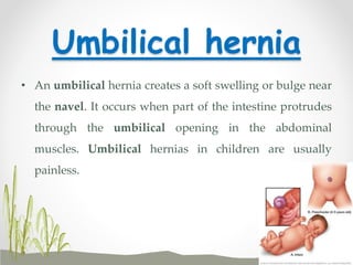 Umbilical hernia
• An umbilical hernia creates a soft swelling or bulge near
the navel. It occurs when part of the intestine protrudes
through the umbilical opening in the abdominal
muscles. Umbilical hernias in children are usually
painless.
 