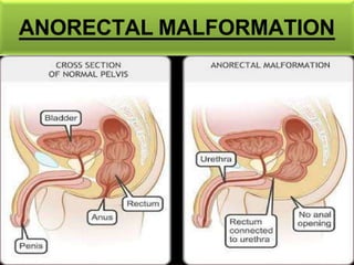 ANORECTAL MALFORMATION
 