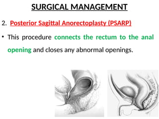 anorectal malformation. pptx | PPTX