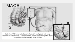 Mace Colon Anorectal Malformation general surgery.pptx