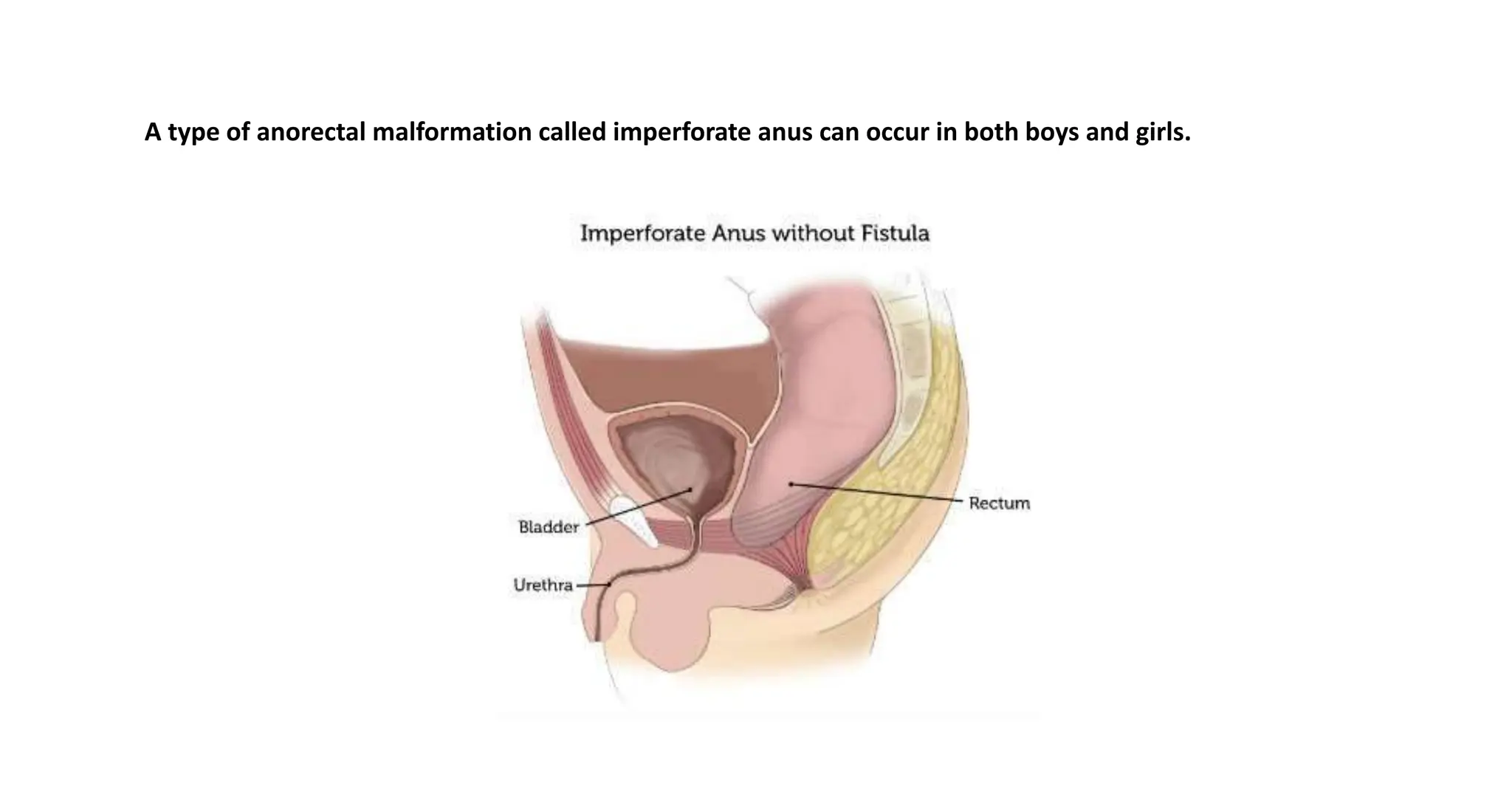 Ano Rectal Malformation congenital abnormality of newborn | PPTX