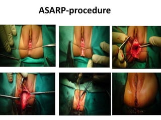 ASARP-procedure
57
 