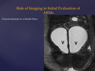 Anorectal malformations | PPTX