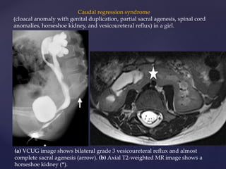 Anorectal malformations | PPTX