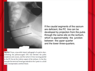 Pcl Line Anorectal malformations | PPTX