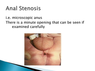 i.e. microscopic anus
There is a minute opening that can be seen if
examined carefully
 
