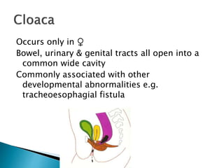Occurs only in ♀
Bowel, urinary & genital tracts all open into a
common wide cavity
Commonly associated with other
developmental abnormalities e.g.
tracheoesophagial fistula
 