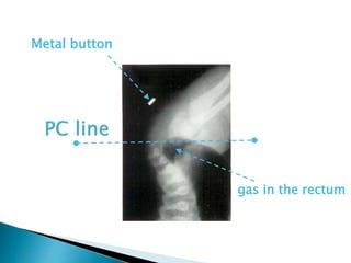 Metal button
gas in the rectum
 