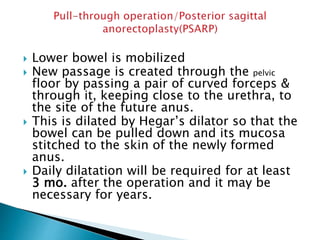  Lower bowel is mobilized
 New passage is created through the pelvic
floor by passing a pair of curved forceps &
through it, keeping close to the urethra, to
the site of the future anus.
 This is dilated by Hegar’s dilator so that the
bowel can be pulled down and its mucosa
stitched to the skin of the newly formed
anus.
 Daily dilatation will be required for at least
3 mo. after the operation and it may be
necessary for years.
 