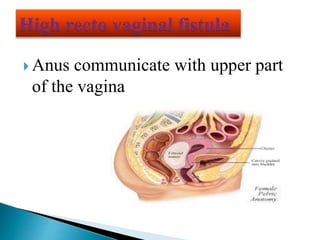  Anus communicate with upper part
of the vagina
 
