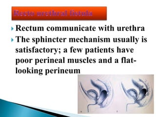  Rectum communicate with urethra
 The sphincter mechanism usually is
satisfactory; a few patients have
poor perineal muscles and a flat-
looking perineum
 
