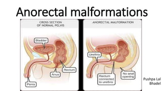Anorectal malformations
Pushpa Lal
Bhadel
 