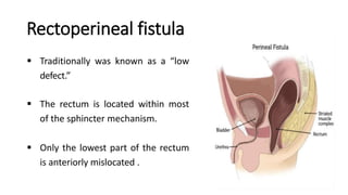 Rectoperineal fistula
 Traditionally was known as a “low
defect.”
 The rectum is located within most
of the sphincter mechanism.
 Only the lowest part of the rectum
is anteriorly mislocated .
 