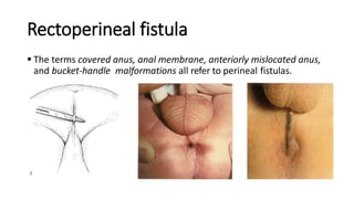 Rectoperineal fistula
 The terms covered anus, anal membrane, anteriorly mislocated anus,
and bucket-handle malformations all refer to perineal fistulas.
 