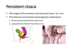 Persistent cloaca
 The length of the common channel varies from 1 to 7 cm.
 This distance has technical and prognostic implications.
1. Short common channel less than 3 cm
2. Long common channel more than 3 cm
 