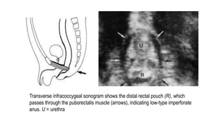 Transverse infracoccygeal sonogram shows the distal rectal pouch (R), which
passes through the puborectalis muscle (arrows), indicating low-type imperforate
anus. U = urethra
 