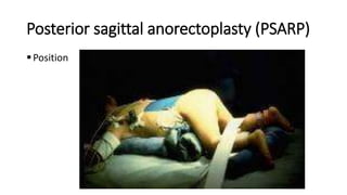 Posterior sagittal anorectoplasty (PSARP)
Position
 