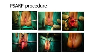 PSARP-procedure
95
 