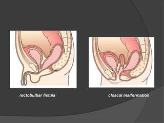 rectobulbar fistula cloacal malformation
 
