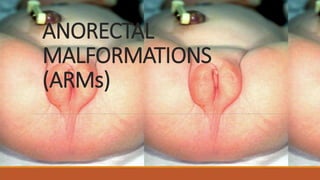 ANORECTAL
MALFORMATIONS
(ARMs)
 
