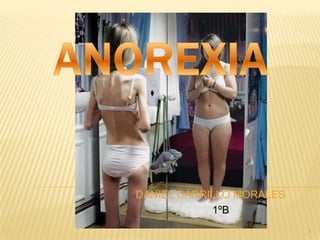 Anorexia DANIEL CARRILLO MORALES     1ºB 1 
