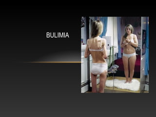 BULIMIA
 